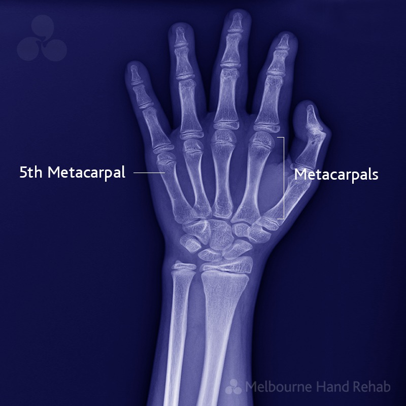 What Is A Boxers Fracture Melbourne Hand Rehab