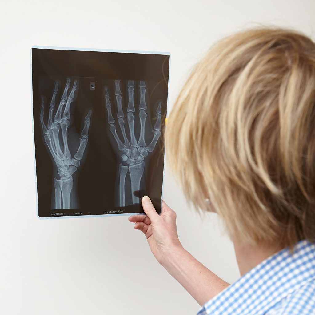 Xray, Broken Wrist, Wrist Sprain, Hand and Wrist Fracture, Clinicians, Hand Therapy