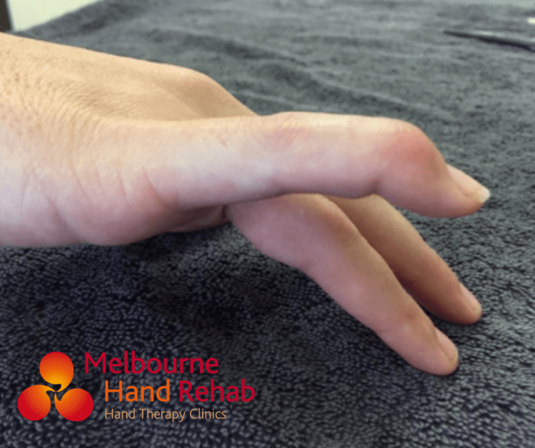 Nailing the discussion on mallet fingers. Melbourne Hand