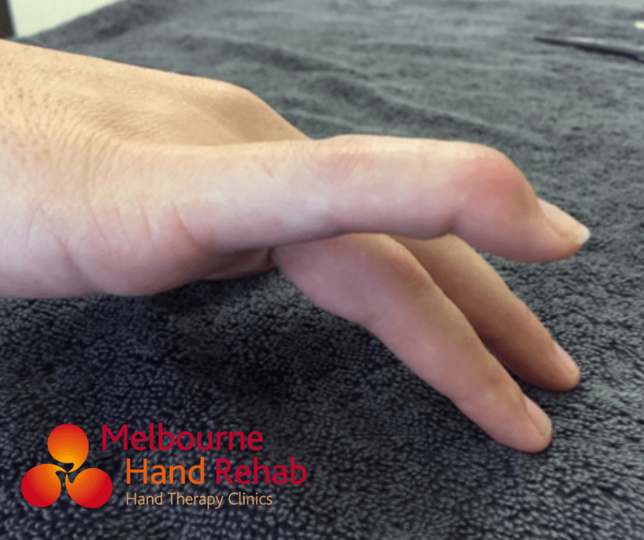 Nailing The Discussion On Mallet Fingers Melbourne Hand