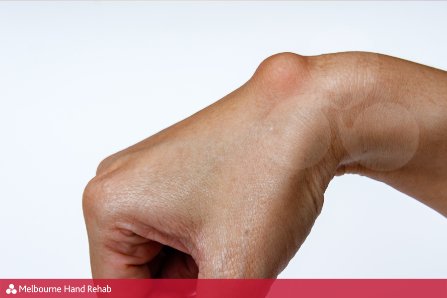 Ganglion cyst on woman hand on white background