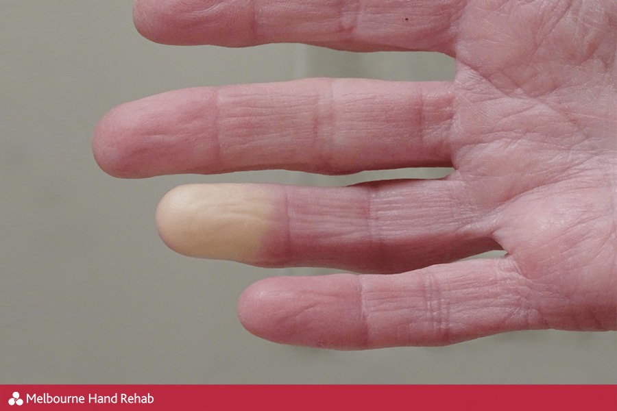 Close up of hand with cold white fingers - Raynaud's Syndrome