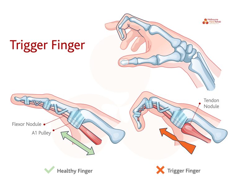 Signs & symptoms of trigger finger | Melbourne Hand Rehab