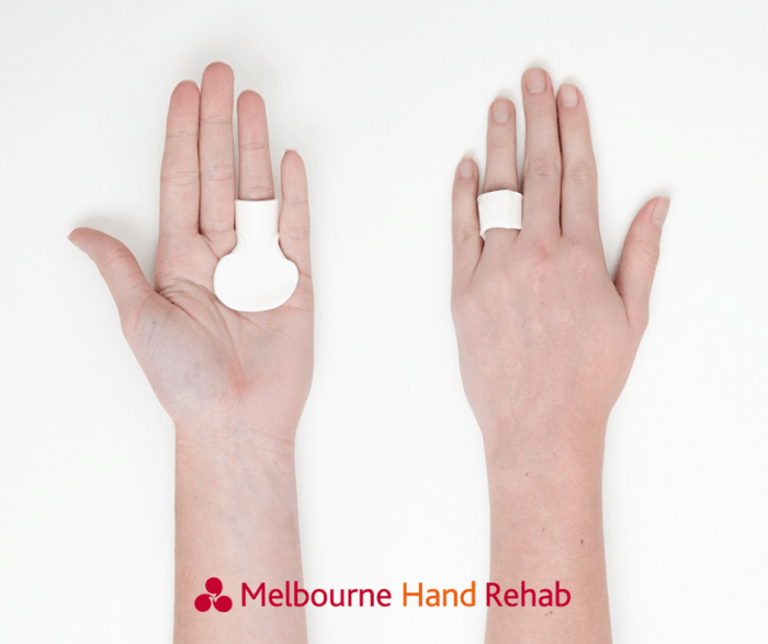 why-is-my-finger-locked-or-clicking-do-i-need-surgery-melbourne-hand