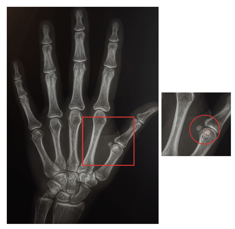 Melbourne Hand Rehab therapists demonstrate a test to determine whether the palmaris longs (PL) tendon is absent in the wrist and forearm