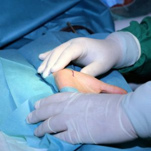 Surgeon operates on patient with carpal tunnel sundrome