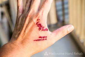 Bleeding hand due to pet bite