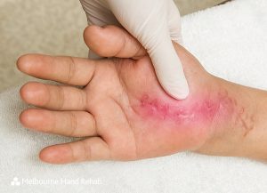 Scar wound on hand. Melbourne Hand Rehab post operative scar management.