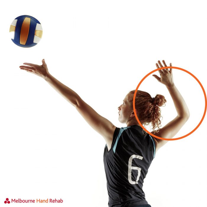 Common upper limb volleyball injuries Melbourne Hand Rehab