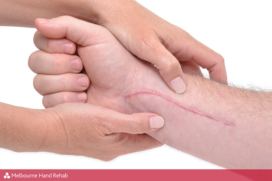 Can I Avoid Scar Tissue After Surgery?