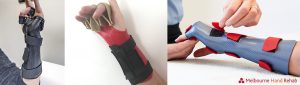 Custom made splints by Melbourne Hand Rehab