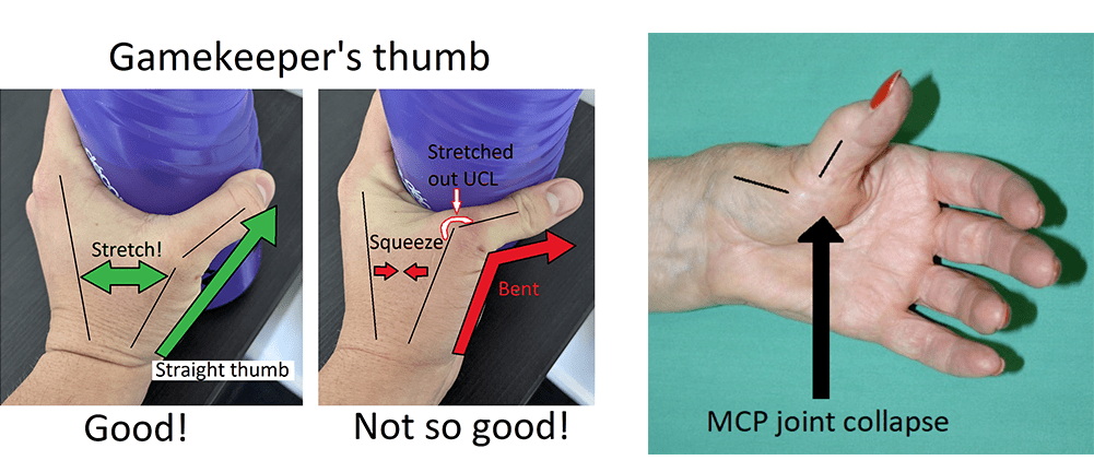 Melbourne Hand Rehab hand therapists can help with issues of thumb instability