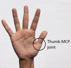 Melbourne Hand Rehab hand therapists can help with issues of thumb instability