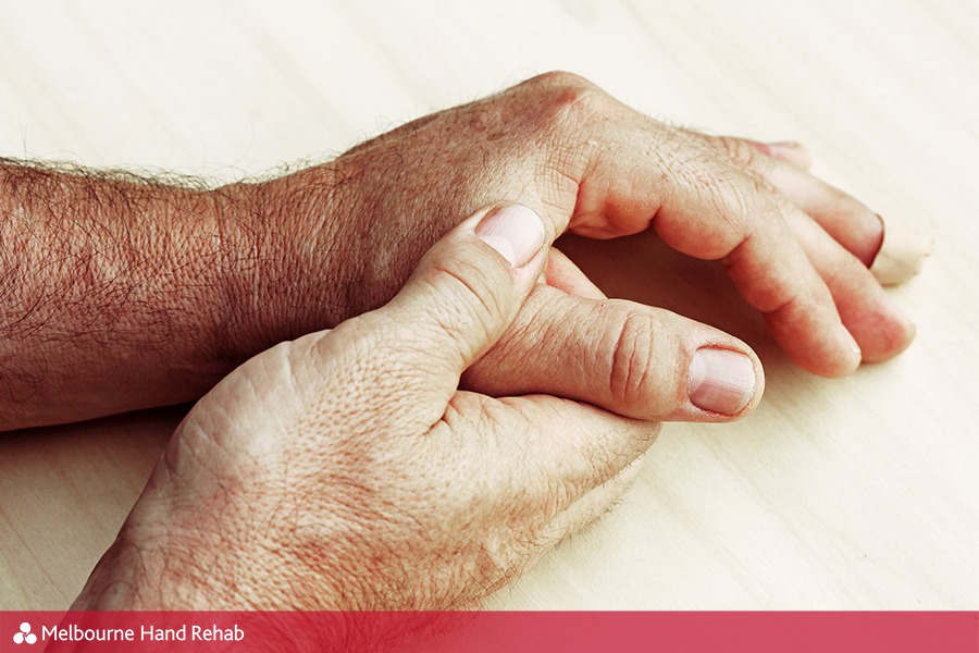 Melbourne Hand Rehab hand therapists can help with issues of thumb instability