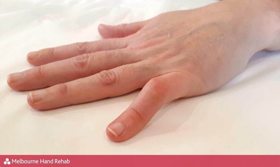 Finger Hurts When Bent gut Doesn't Swell: 5 Causes | Excel PTExcel Sports PT