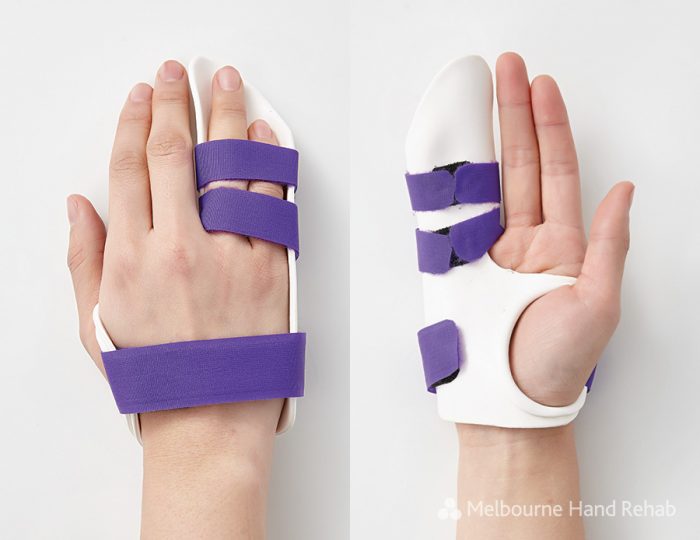 Dupuytren’s Disease Treatment Melbourne Hand Rehab