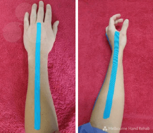 Melbourne Hand Rehab hand therapist shows an example of the neutral wrist