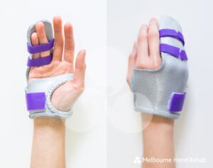 Melbourne Hand Rehab custom made splints and braces