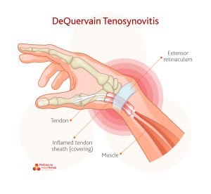 What is DeQuervain's Tenosynovitis?
