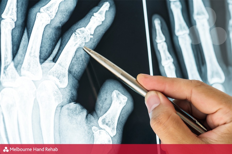 What happens if you don't get treatment for a broken finger?