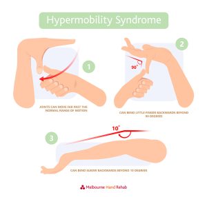 Do you think you are double jointed? What is hypermobility syndrome?