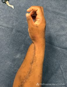 An example of a crush/roller injury requiring multiple surgeries including tendon transfers, tendon grafting, infection debridement and skin grafts. 