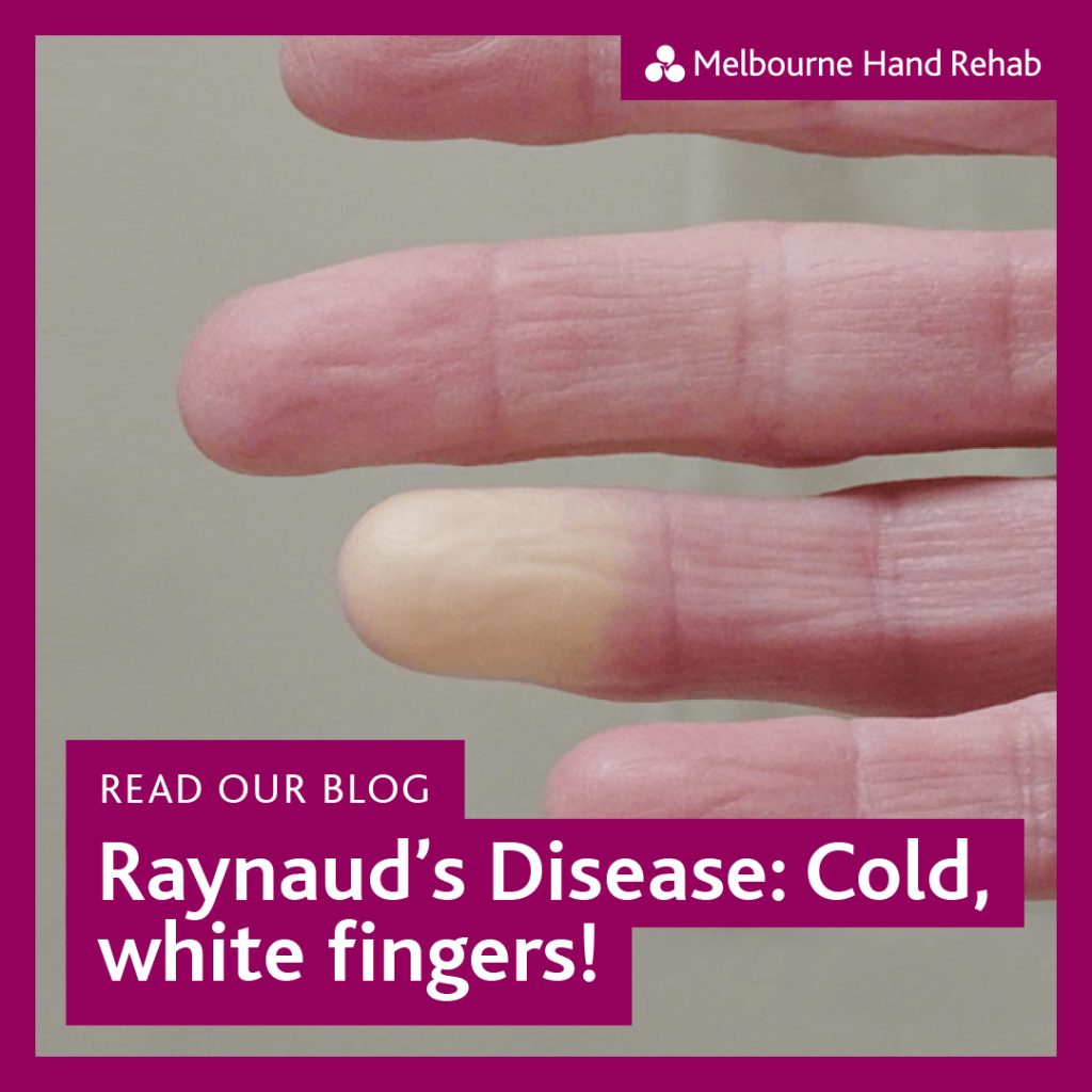 Read our blog: Raynaud's Disease: Cold, white fingers!
