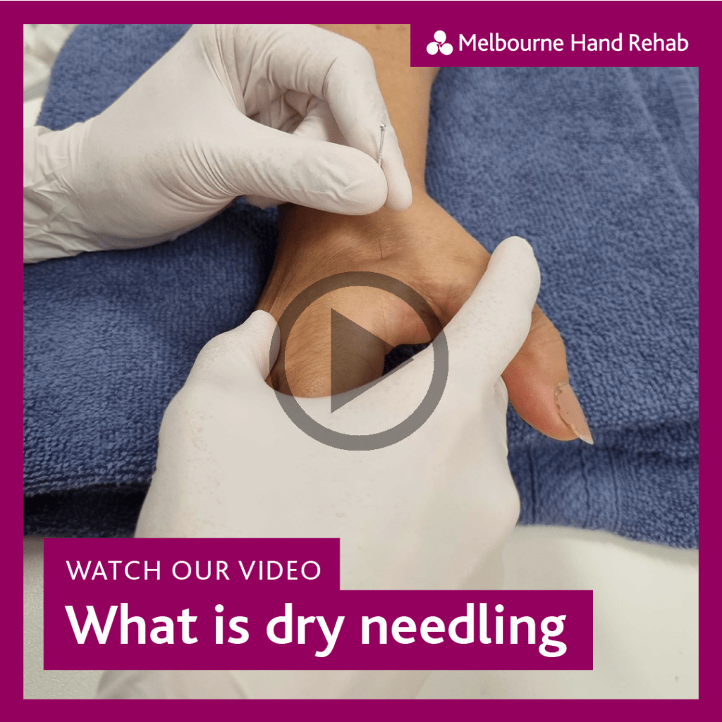 Watch our video: What is dry needling?