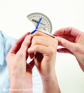 What is a goniometer? Unlocking movement: The role of goniometers in Hand Therapy.