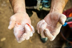 Read our blog: Common rock climbing injuries