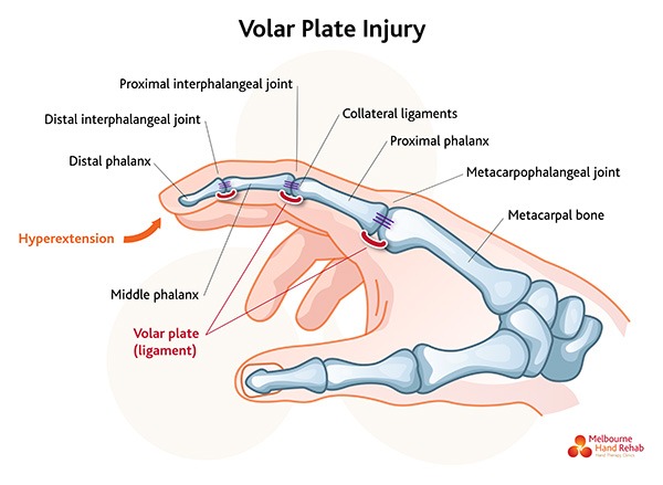 Read our blog: Volar plate injuries