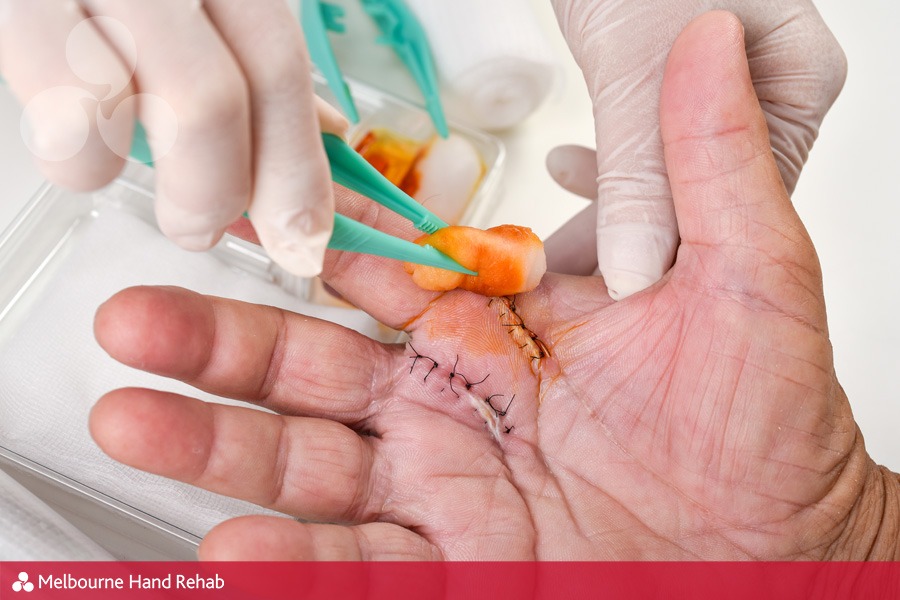 Read our blog: Important things to know after hand surgery.