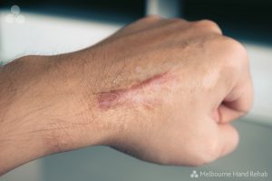 Read our blog: Effective scar management.