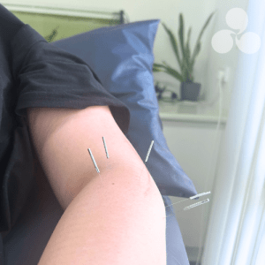 Dry Needling at Melbourne Hand Rehab