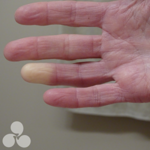 Raynaud’s Disease