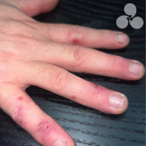 Raynaud’s Disease